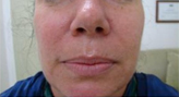 Patient # 33587 After Photo # 2